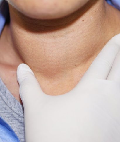 hasimatodabeslenme Asian lady woman patient have abnormal enlargement of thyroid gland Hyperthyroidism (overactive thyroid) at the throat : healthy strong medical concept