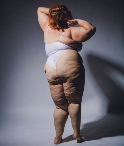 lipodemfoto lipodemfoto